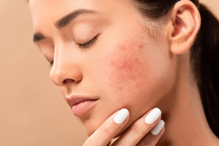 Acne Scar Treatment