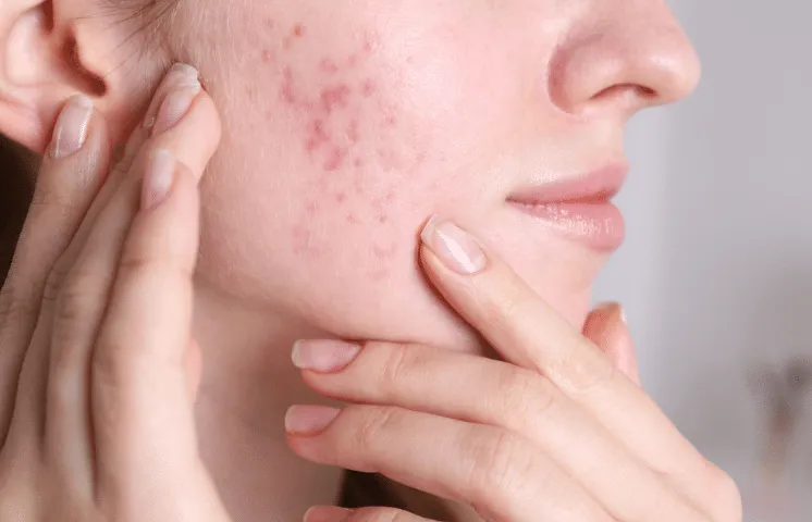 Acne Scar Treatment